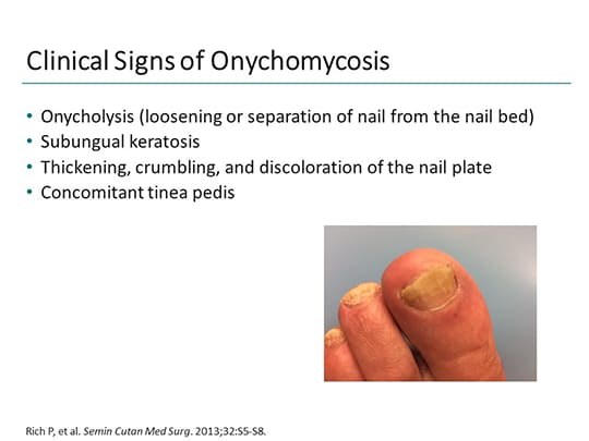 Before and After: Patient Cases in Onychomycosis (Transcript)