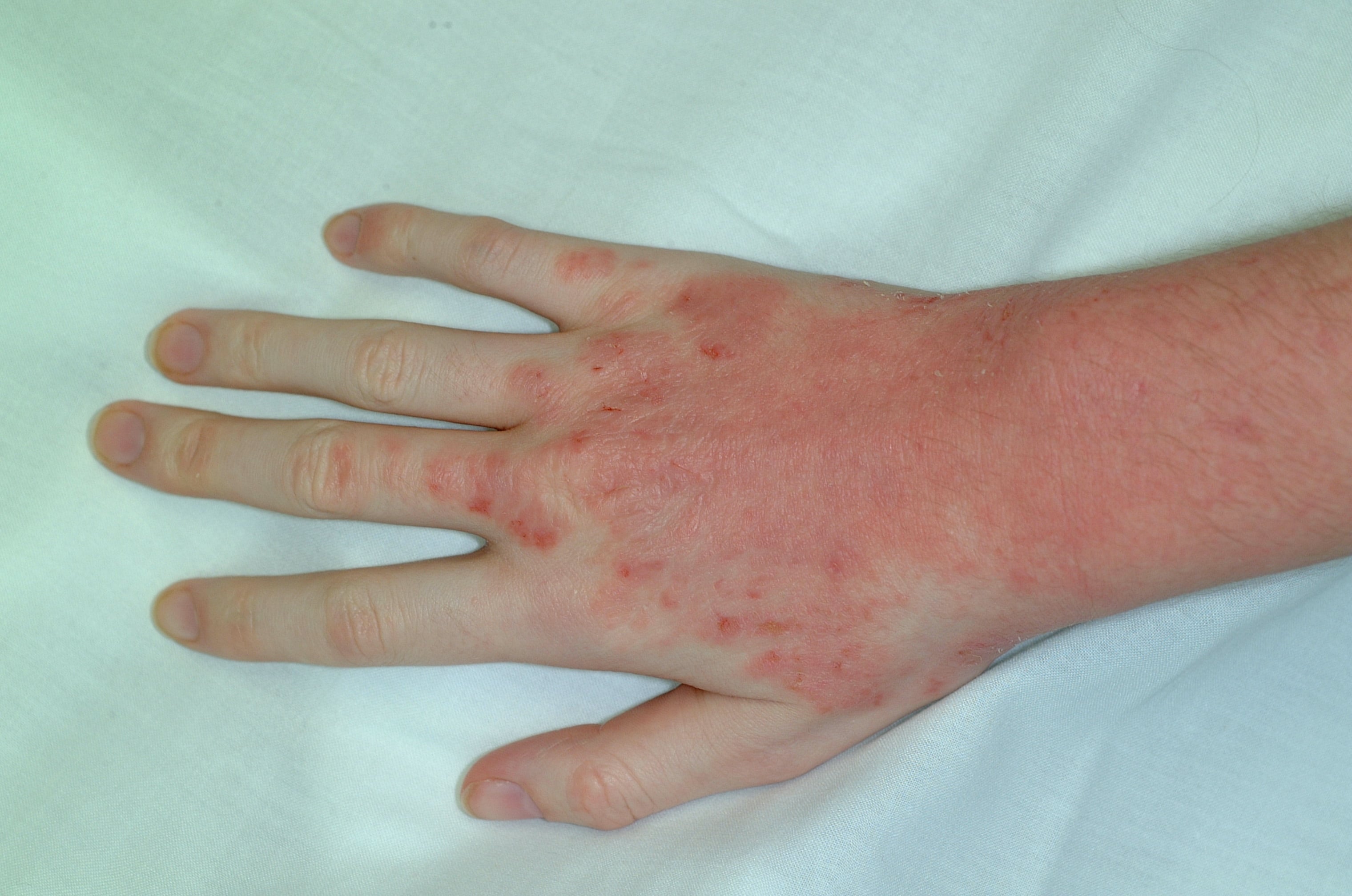 Can You Diagnose and Treat These Patients With Pruritus and Relapsing ...