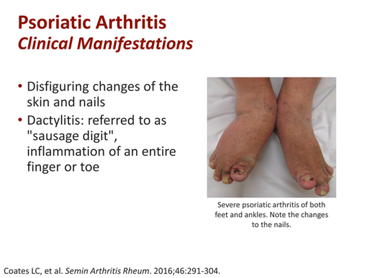 Effective Management Of Psoriatic Arthritis: Tailoring Treatments ...