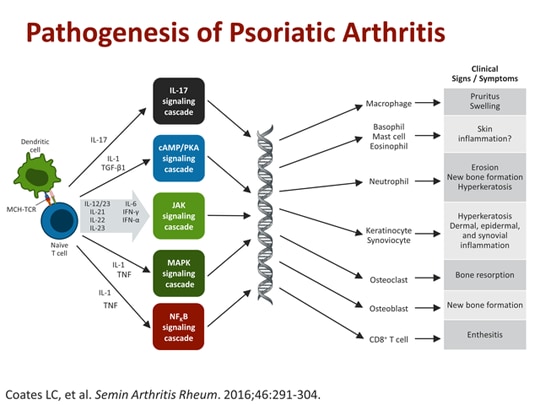 Effective Management of Psoriatic Arthritis: Tailoring Treatments ...