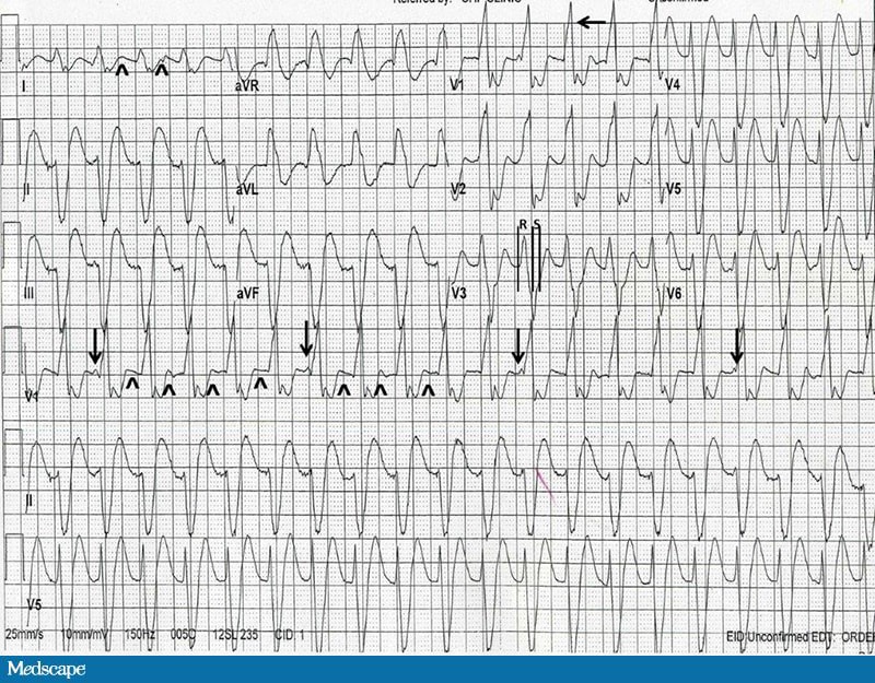 ECG Challenge: Mid-Fifties and Feeling Faint - Page 2