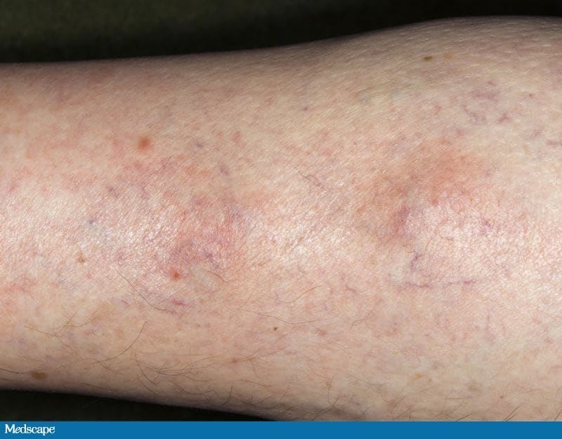 A 34-Year-Old Woman With Knots on Her Leg and Reddening Skin