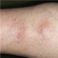 A 34-Year-Old Woman With Knots on Her Leg and Reddening Skin