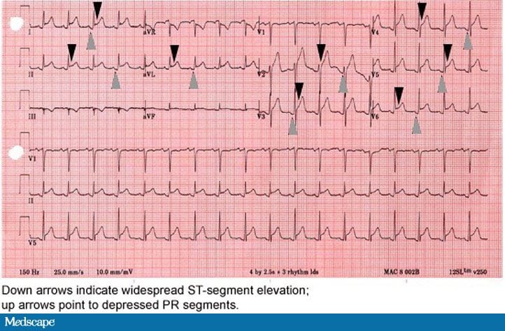 Dull Chest Pain in a 42-Year-Old Man - Page 3