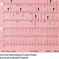 Dull Chest Pain in a 42-Year-Old Man - Page 3