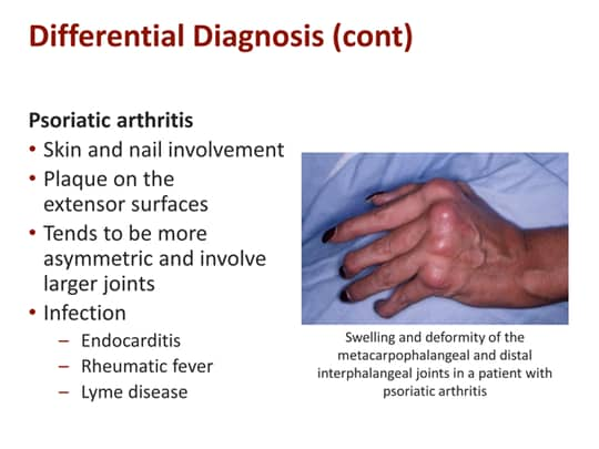 Diagnosing Rheumatoid Arthritis Early: A Guide for Primary Care