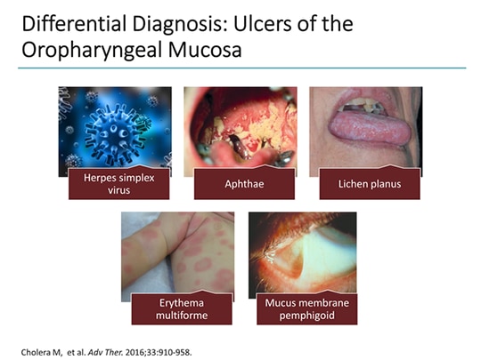 A Closer Look At Pemphigus Vulgaris: Clinical Challenges And Emerging ...