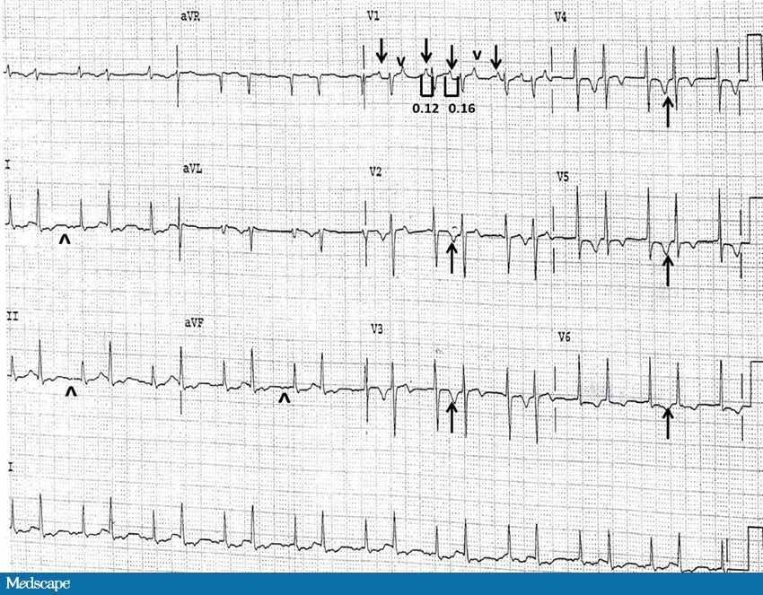 ECG Challenge: A Hypertensive Crisis - Page 2