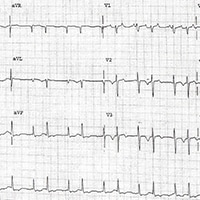 ECG Challenge: A Hypertensive Crisis