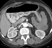 A 57-Year-Old Woman With Bloody Diarrhea - Page 2