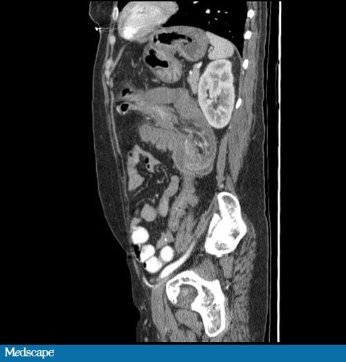A 57-Year-Old Woman With Bloody Diarrhea - Page 2