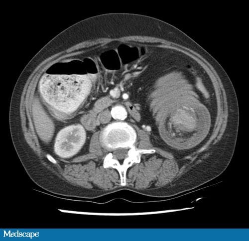 A 57-Year-Old Woman With Bloody Diarrhea - Page 2