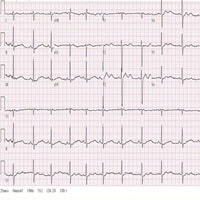 A 23-Year-Old Unaware She’s Pregnant With ECG Abnormalities - Page 2