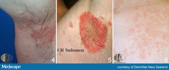 I Can T Take This Rash Anymore