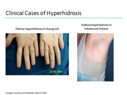 Hyperhidrosis Is Burdensome! How To Diagnose It Sooner