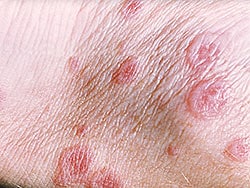 Fast Five Quiz Erythema Multiforme Fast Five Quiz Erythema Multiforme