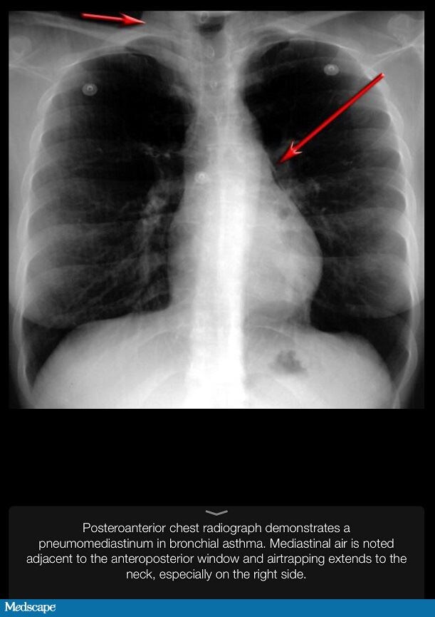 A 43YearOld Woman With Dyspnea, Cough, and Chest Tightness