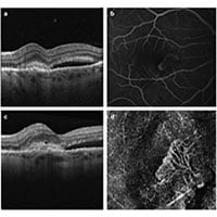 The Use of Optical Coherence Tomography Angiography for Detecting ...