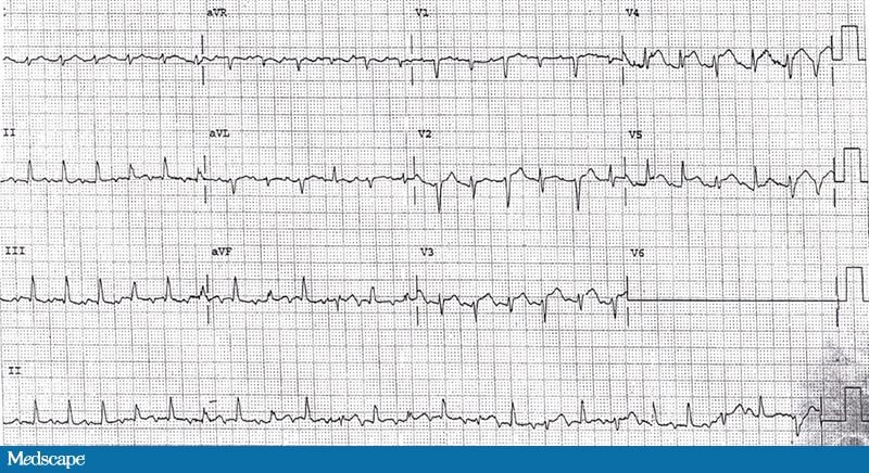 ECG Challenge: No Ma'am, It's Not Indigestion