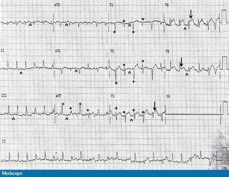 Ecg Challenge: No Ma'am, It's Not Indigestion - Page 2