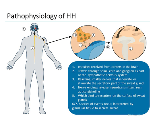 Hyperhidr Why New Treatments for Hyperhidrosis Should Be on Your Radar