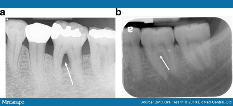 Comparing Methods of Molar Furcation Assessment - Page 3