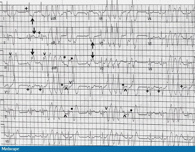 Crushing Chest Pain What Does His ECG Show? Page 2