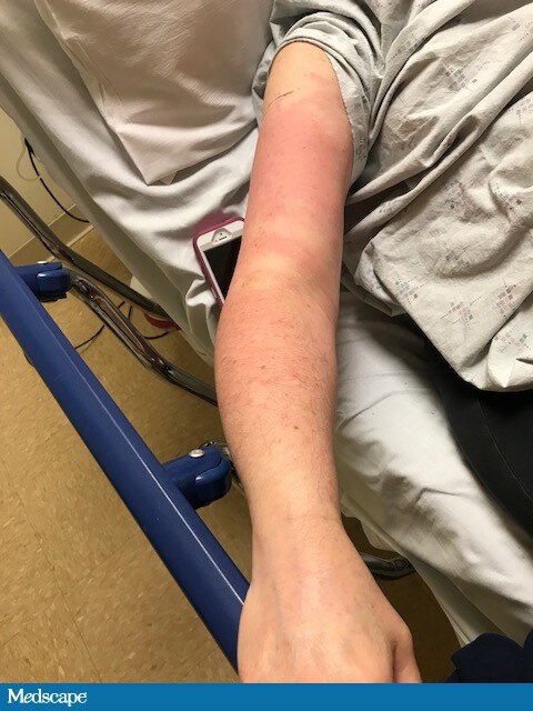 Cellulitis Mimics Dermnet Nz