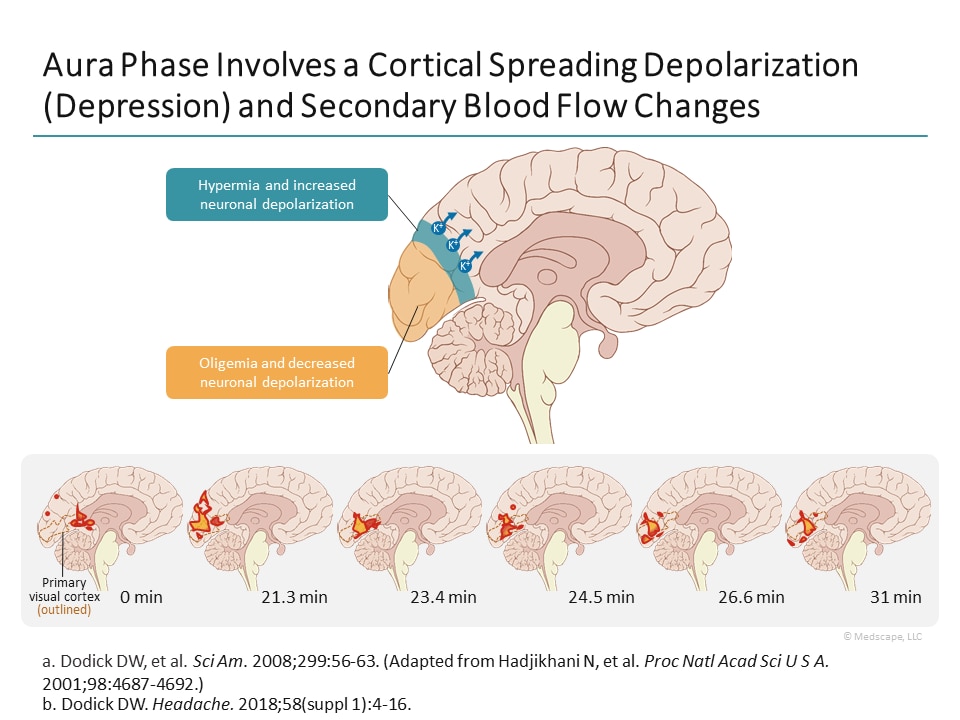 The Biologic Basis of Migraine (Transcript)