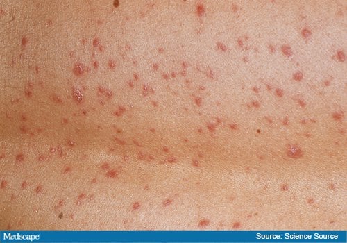 Fast Five Quiz: Psoriasis Types - Page 4