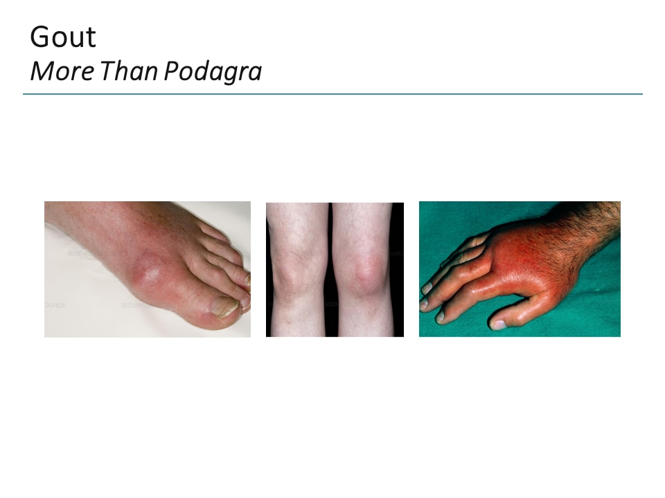 Optimizing Treatment Of Refractory Gout