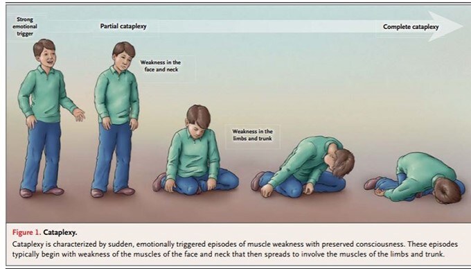 cataplexy seizures cataplexy seizures