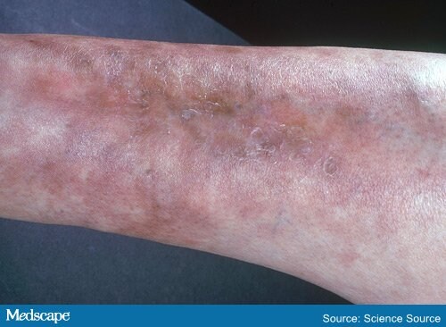 A 59-Year-Old Woman With Painful Rash on Her Elbows - Page 2