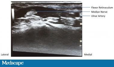 Skill Checkup: Carpal Tunnel Steroid Injection