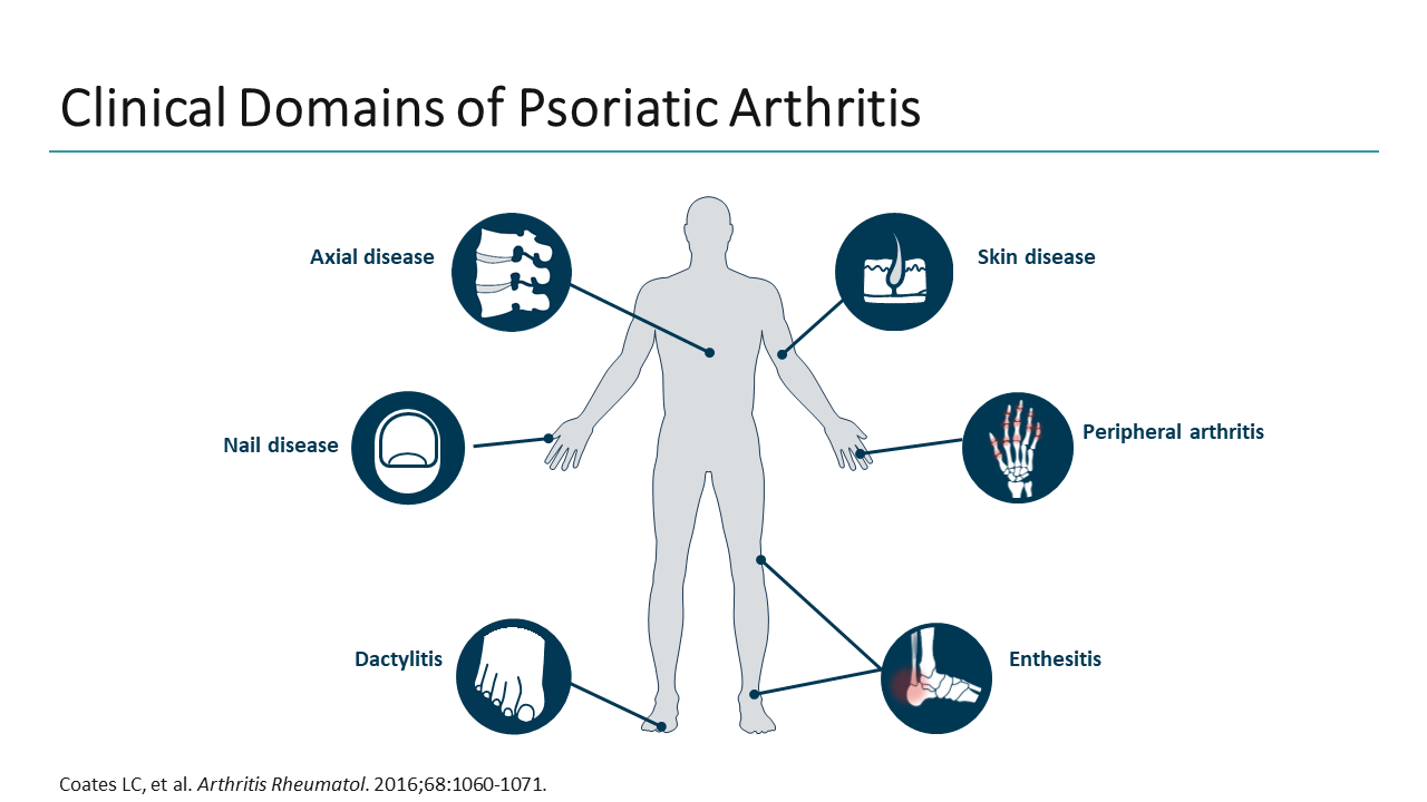 Integrating Novel Therapies In Psa: Guided Steps To Shared Decision 