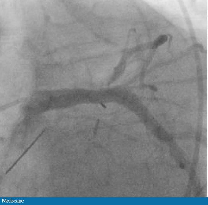 Dyspnea in a 63-Year-Old Who Had Heart Surgery as a Child - Page 2