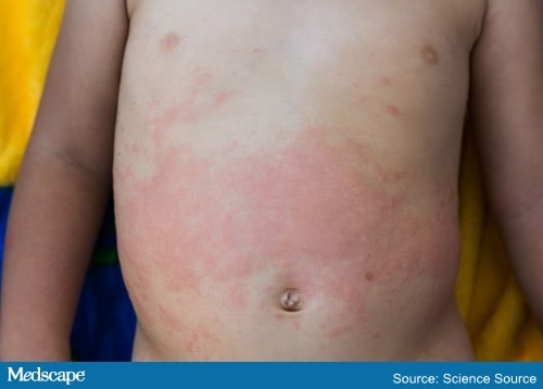 Nightly Fever, Swollen Lymph Nodes, and Rash in a 3-Year-Old