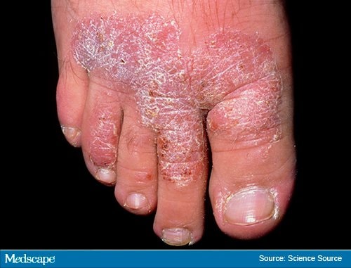 Fast Five Quiz: Plaque Psoriasis - Page 3