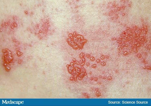 Fast Five Quiz: Herpes Zoster Postherpetic Neuralgia