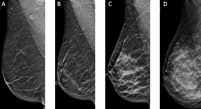 Advances in Breast Cancer Screening