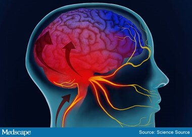 Fast Five Quiz Migraine Variants fast five quiz migraine variants