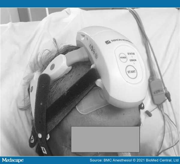Continuous EEG Monitoring by a Wireless Headset in ICU