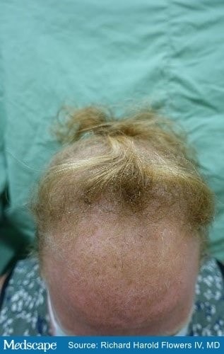 Clitoromegaly, Amenorrhea, and Hair Loss in a 32-Year-Old