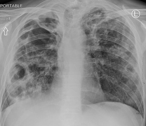 A 44-year-old Woman With A Chicken Coop Has Dyspnea And Cough - Page 3