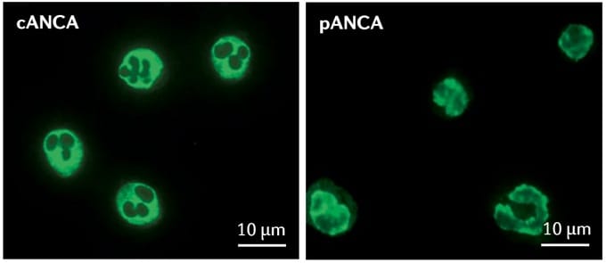 P Anca Pattern Case Challenges in Small-Vessel Vasculitis: Can You Diagnose and Manage ...