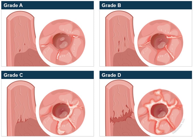 Updates in the Management of Erosive Esophagitis