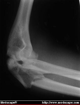 Indications for Radial Head Replacement Following Elbow Trauma - Page 2