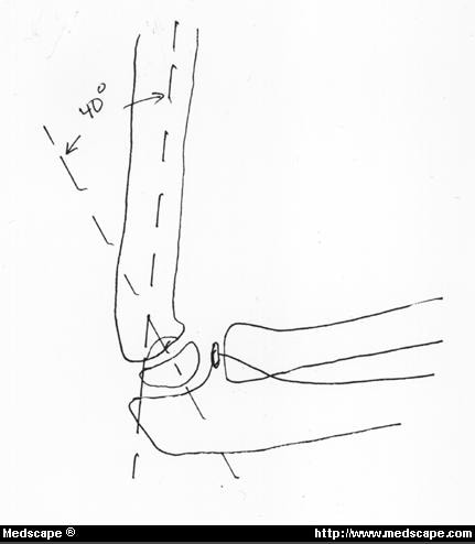 Supracondylar and Lateral Condyle Fractures of the Humerus in ...