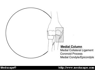 Restoring Elbow Stability After Fracture-Dislocation Part I: Elbow ...