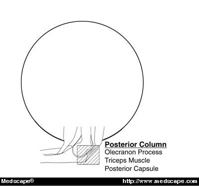 Restoring Elbow Stability After Fracture-Dislocation Part I: Elbow ...